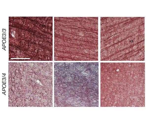 Alzheimer's risk gene undermines insulation of brain's wiring