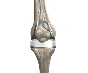 Radiation boost for artificial joints