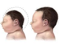 World must ready for global microcephaly 'epidemic': study