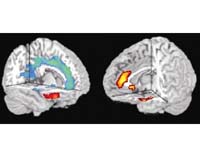 IBM makes MRI scans 100 million times better