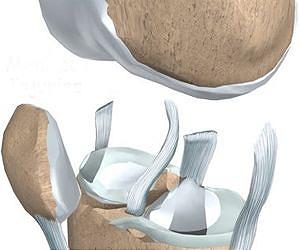 Nanoscale scaffolds and stem cells show promise in cartilage repair