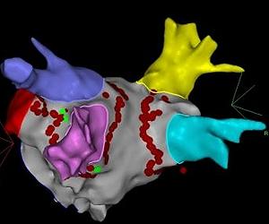 Robo-Op Marks New World First For Heart Procedure