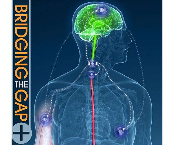 Metamaterial spinal implant from Pitt sends wireless signals to track healing with no batteries