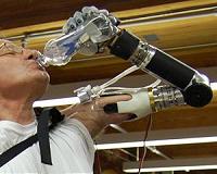 Advanced prosthetic arm is approved for US market