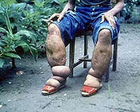 DNA Barcoding Of Mosquito Species Deployed In Bid To End Elephantiasis