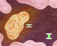 Shape-shifting sensor can report conditions from deep in the body