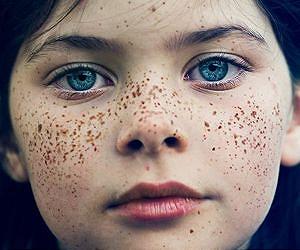 Researchers identify genomic variant associated with sun sensitivity, freckles
