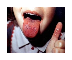 Vaccine hopes for hand, foot, mouth disease