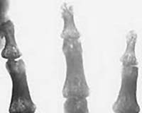Hydrogels: Scaffolding for bone cells