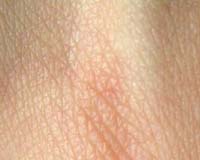 Types Of Skin Diseases Among Military Personnel Evacuated From Combat Zones