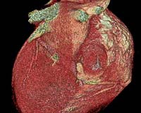 Stem cell-heart attack trial begins