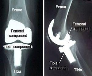 Smallest tools could give biggest results in bone repair