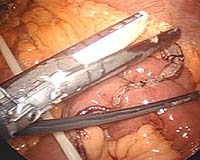 Surgical Implants Coated With One Of Nature's Antibiotics
