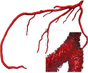 3D Model Of Blood Flow By Supercomputer Predicts Heart Attacks