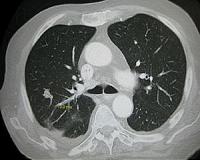 Nanoparticles derived from tea leaves destroy lung cancer cells: Quantum dots have great potential