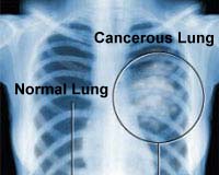 Lung, skin cancer genetic codes mapped