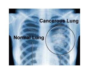 CT detects twice as many lung cancers as X-ray at initial screening exam