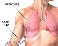 Observations From Space: NASA Environmental Data And Lung Disease