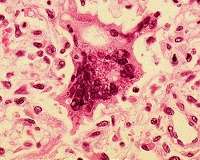 China measles Study has implications for worldwide epidemic control