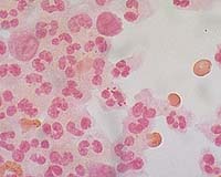 Toll in Burkina meningitis epidemic rises to 441