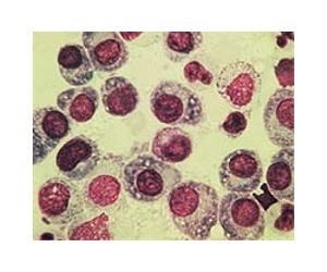 Radiation Pharmacogenomics Personalize Cancer Treatment