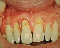 Gum disease feared to trigger full-blown AIDS: Japan study