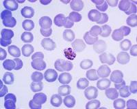 First drug-resistant malaria parasite detected in Africa