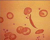 Genetic blood variations in diseases ID'd