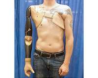 Surgical technique improves sensation, control of prosthetic limb