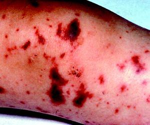 Bio-hybrid device acts as 'thermostat' to control systemic inflammation in sepsis