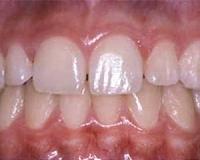 Enamel evolved in the skin and colonized the teeth much later