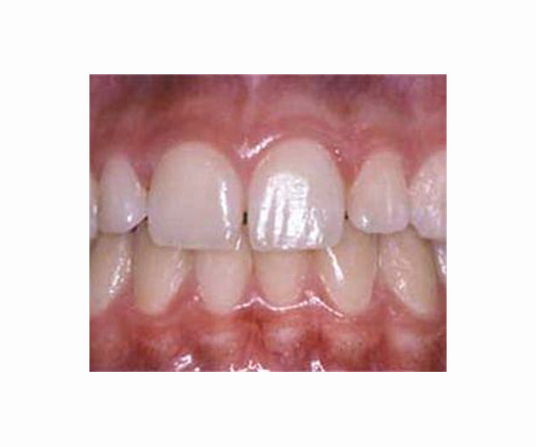 Polymers in water at dentist can prevent aerosol mists that spread germs