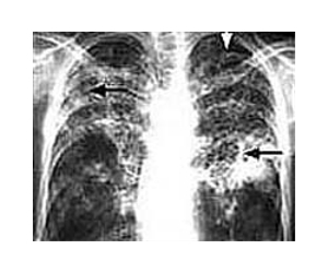 TB still kills millions of poor, says WHO