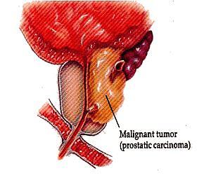 Virginia Tech study finds virus promising for prostate cancer treatment